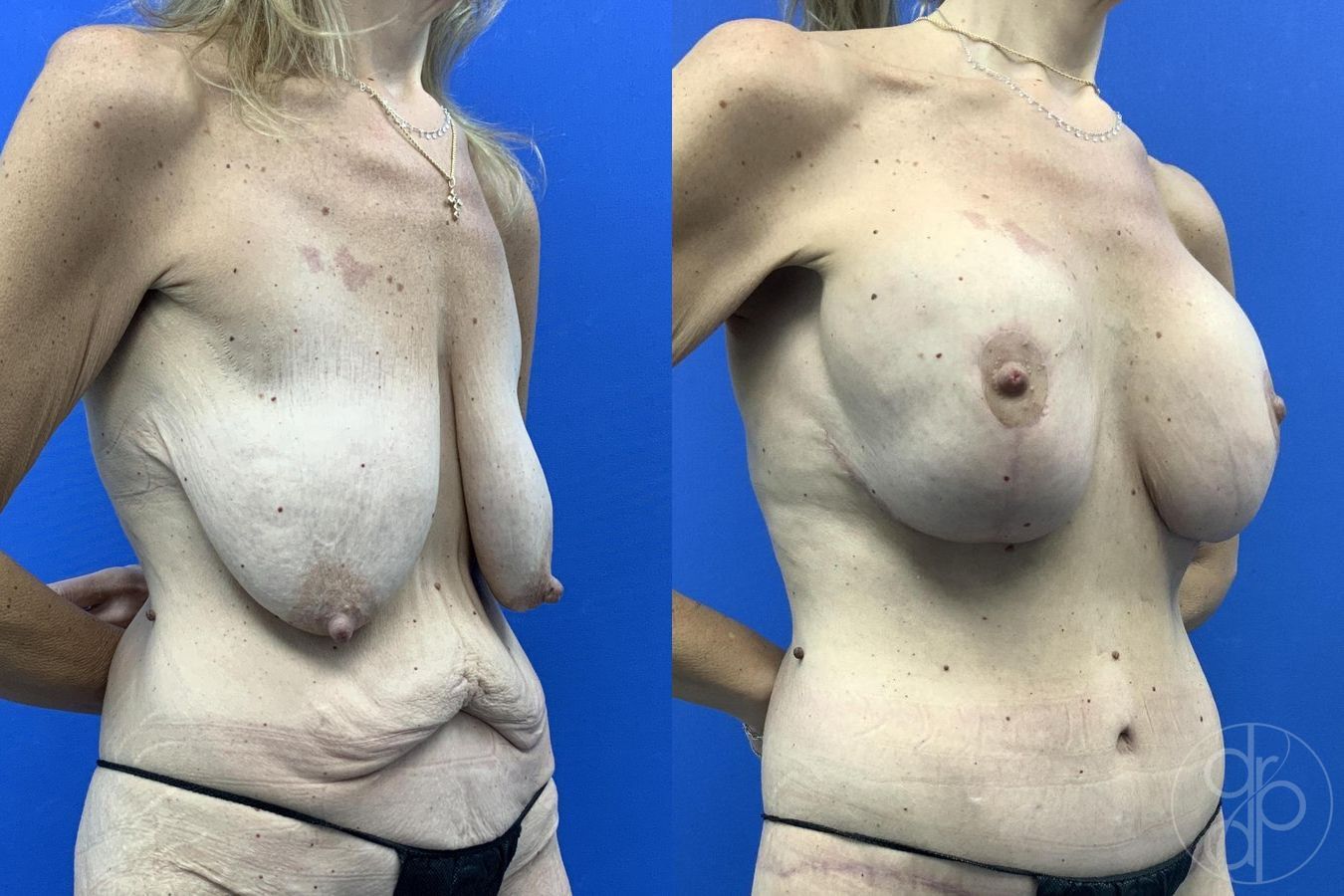 Before and after Breast Augmentation with Lift case 29629 - Angle 3
