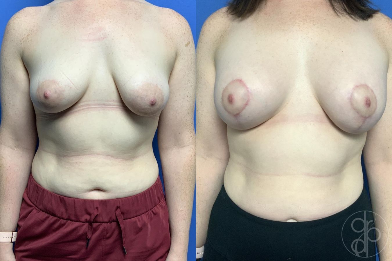 Before and after Breast Augmentation with Lift case 29782