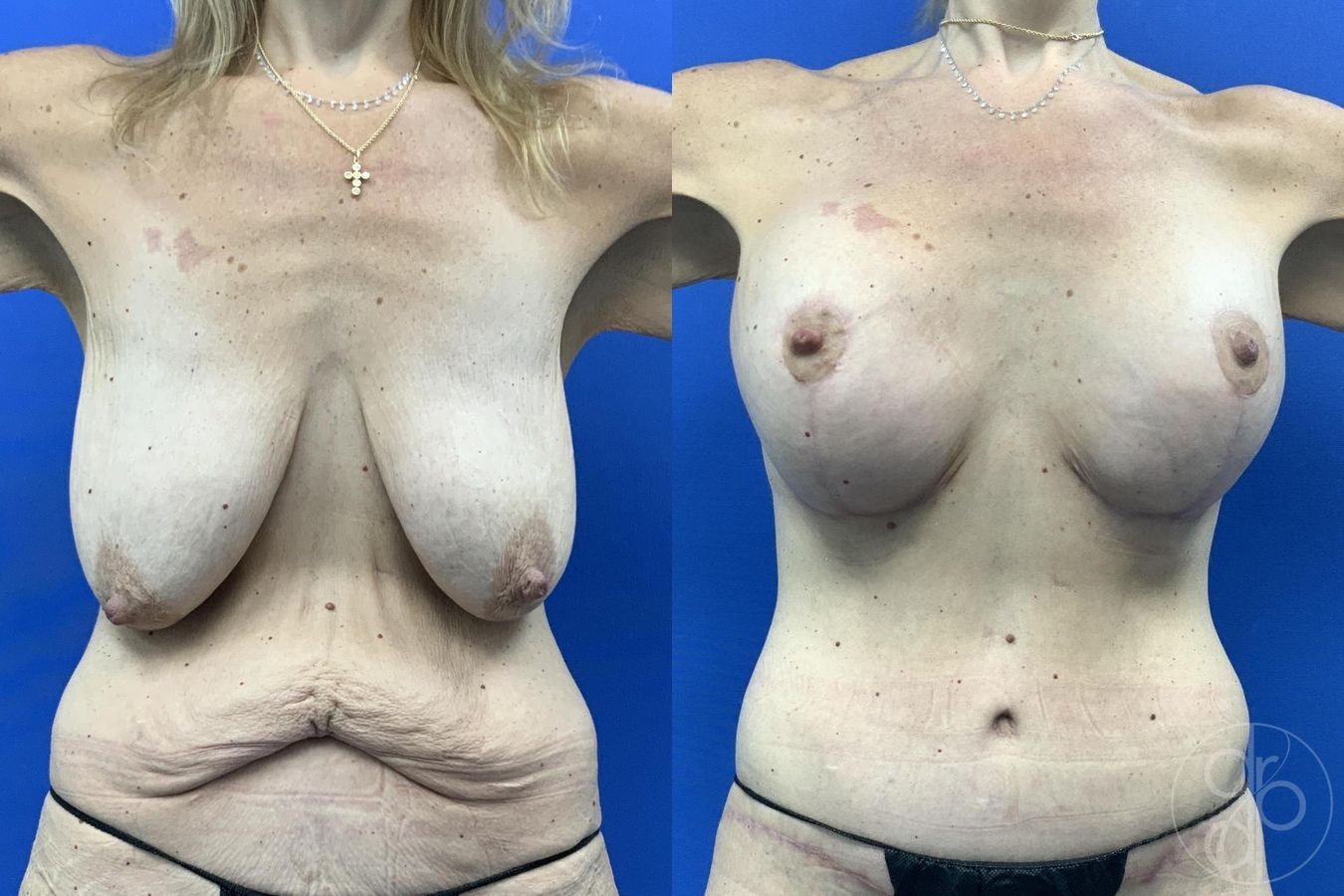 Before and after Breast Augmentation with Lift case 29629 - Angle 2