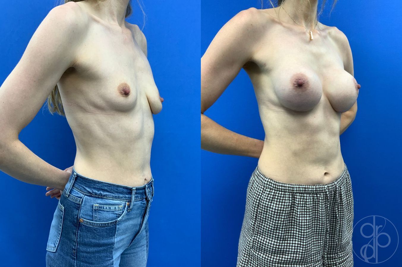 Before and after Breast Augmentation case 46255 - Angle 4