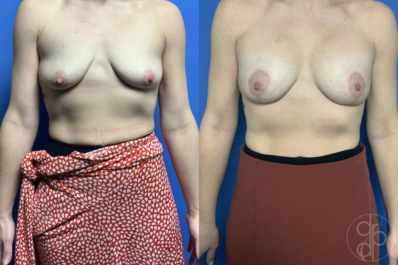 Before and after Breast Augmentation with Lift case 29799