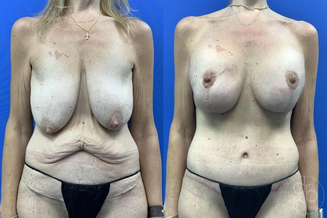 Before and after Breast Augmentation with Lift case 29629