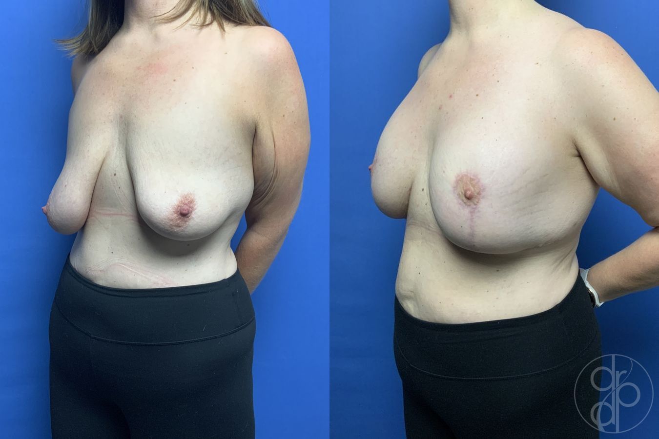 Before and after Breast Augmentation with Lift case 29870 - Angle 2
