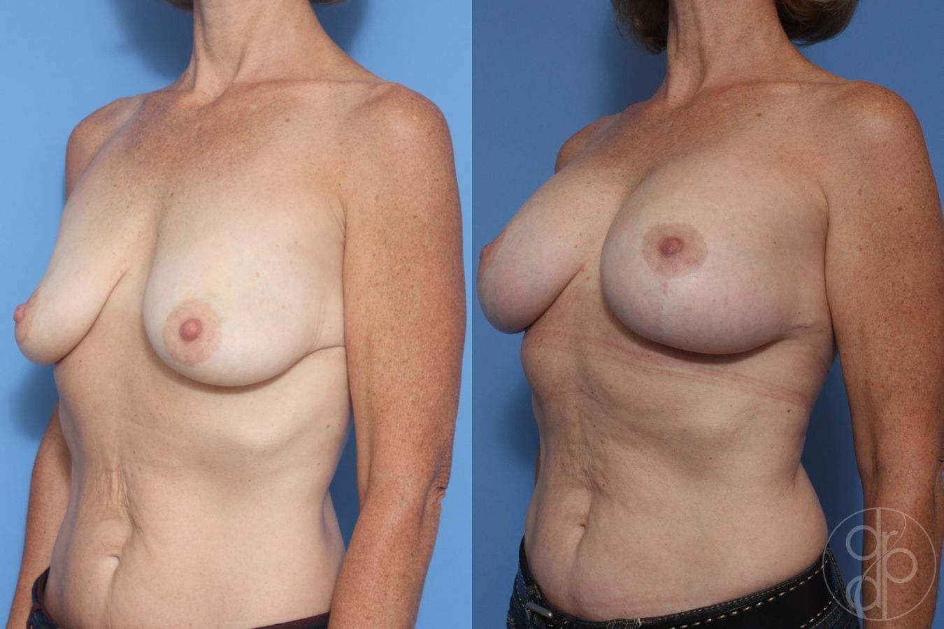 Before and after Breast Augmentation with Lift case 29869 - Angle 2