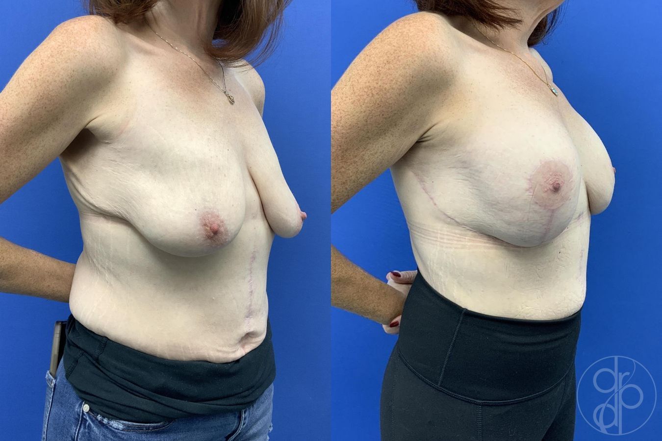 Before and after Breast Augmentation with Lift case 30017 - Angle 3