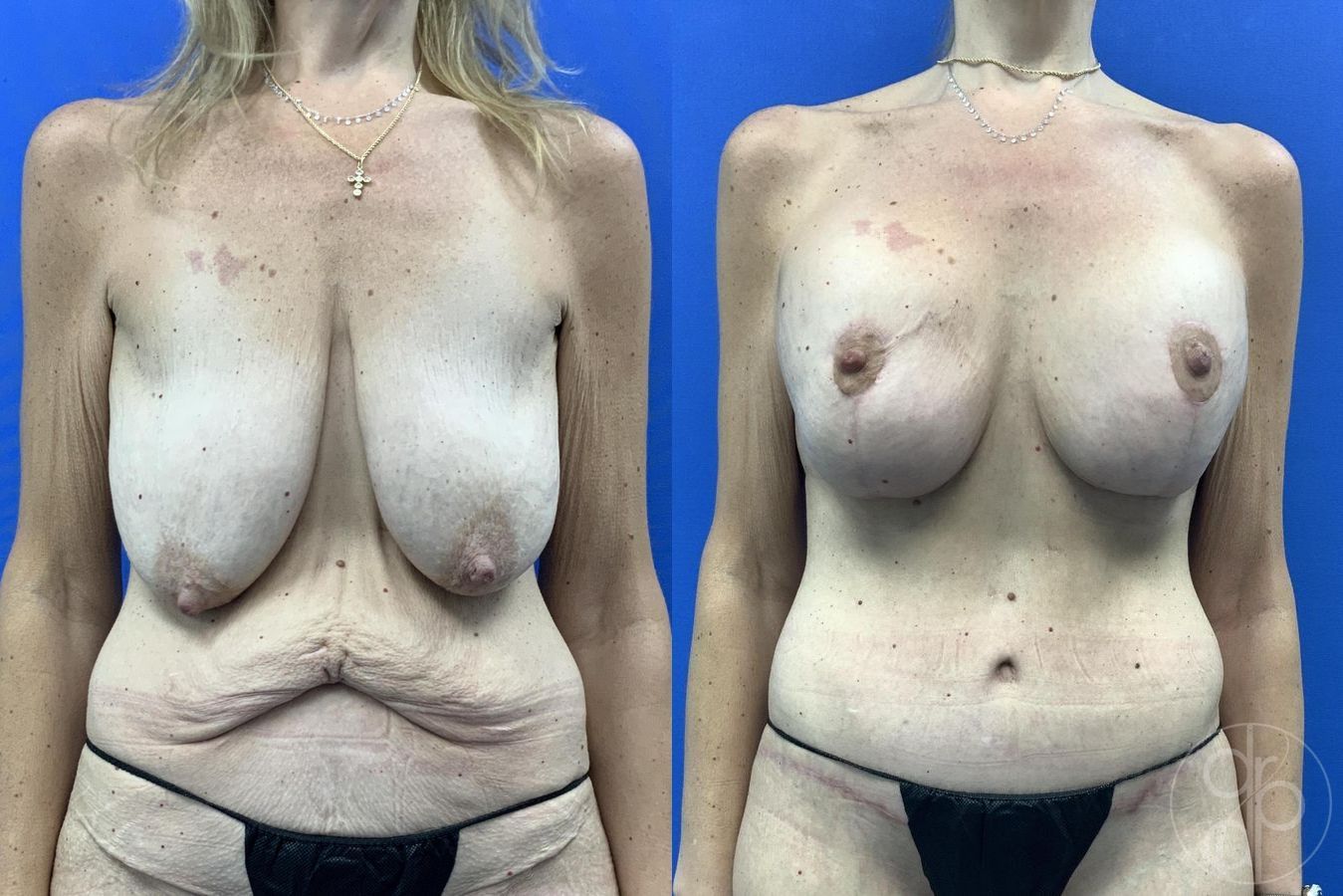Before and after Breast Augmentation with Lift case 29629