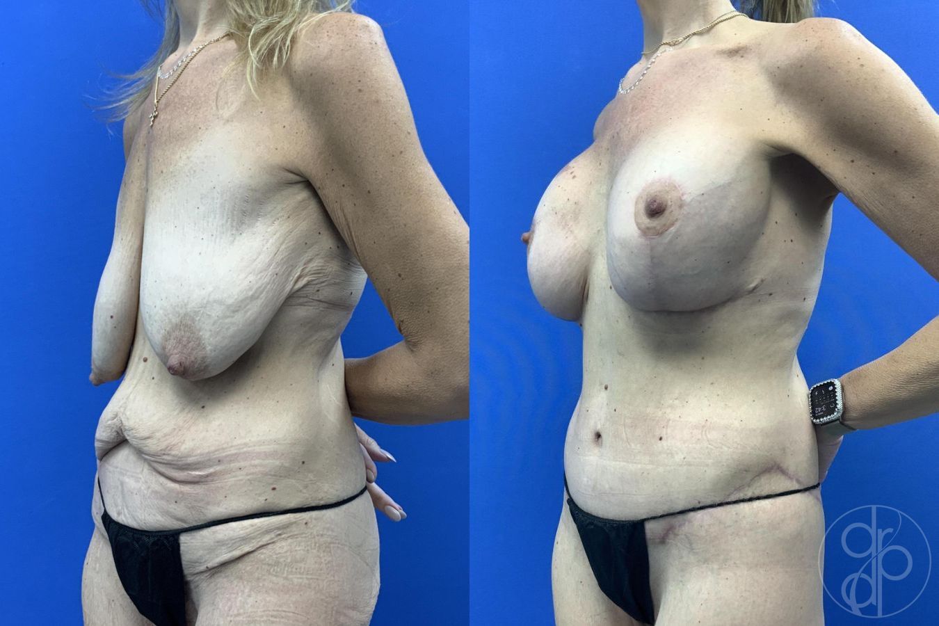 Before and after Breast Augmentation with Lift case 29629 - Angle 4