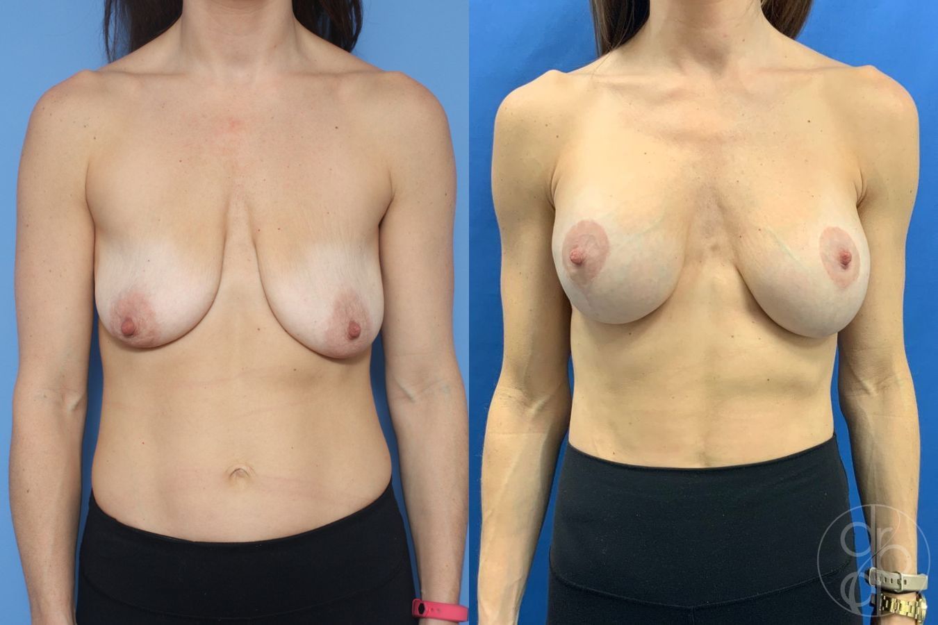 Before and after Breast Augmentation with Lift case 29866