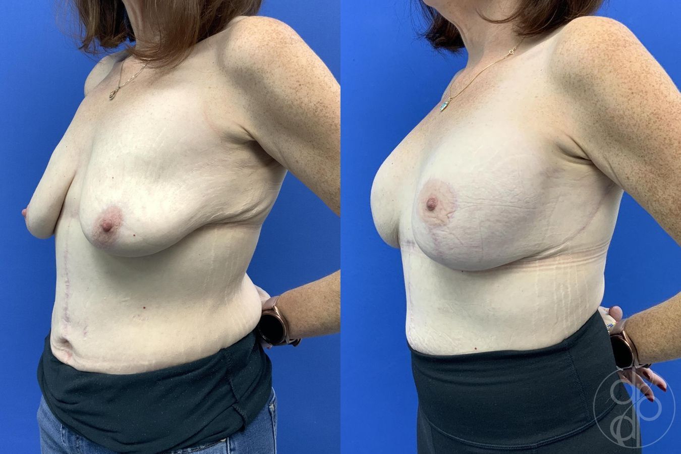 Before and after Breast Augmentation with Lift case 30017 - Angle 4
