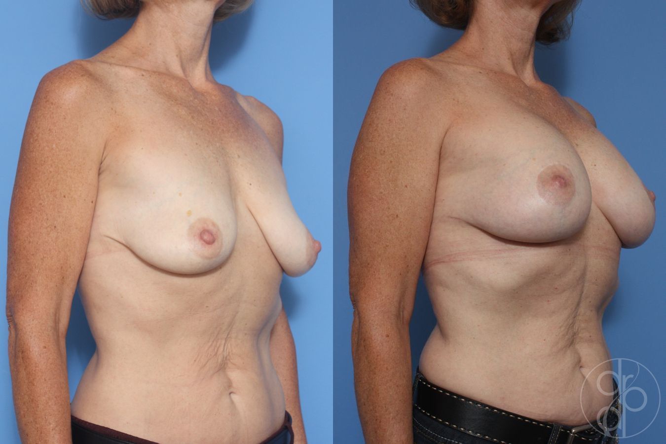 Before and after Breast Augmentation with Lift case 29869 - Angle 3