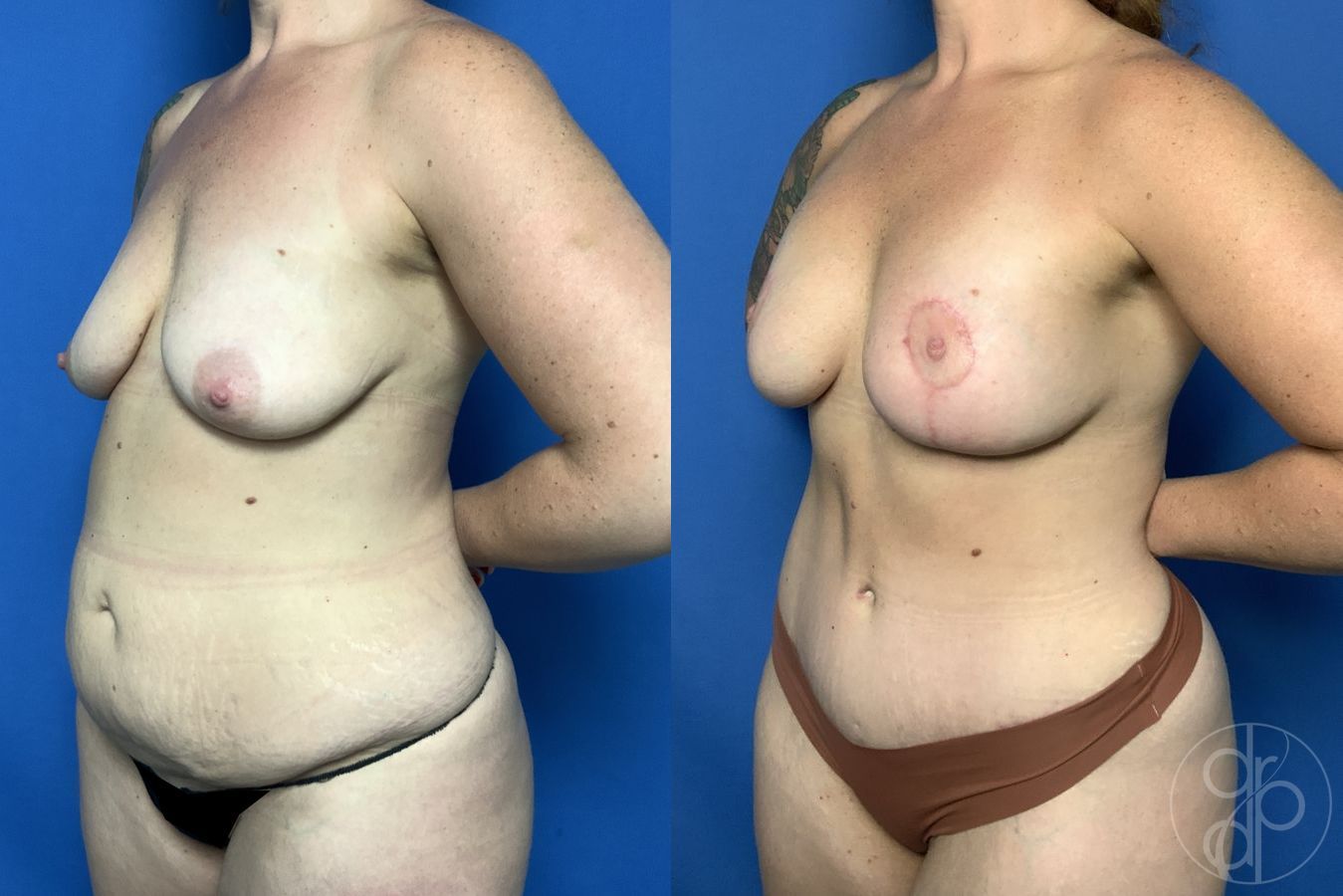 Before and after Breast Augmentation with Lift case 29735 - Angle 2