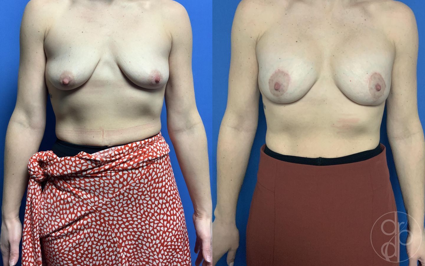 Before and after Breast Augmentation with Lift case 29799