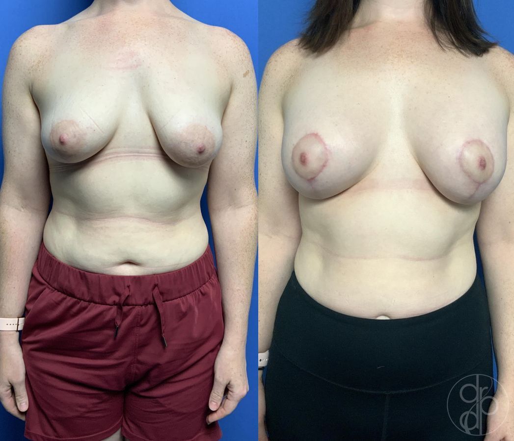 Breast Augmentation with Lift - Case 477