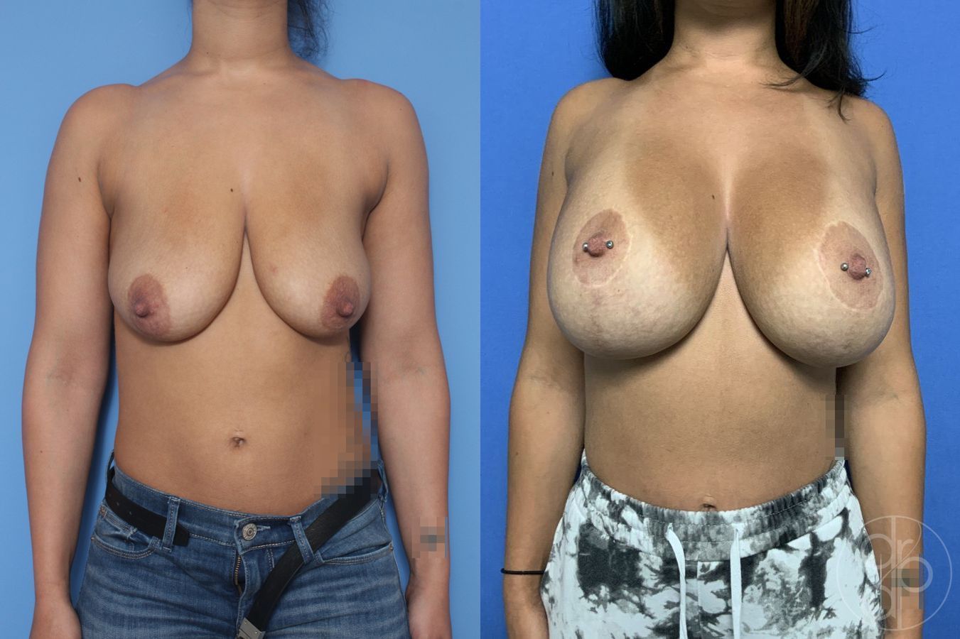 Breast Augmentation with Lift - Case 475