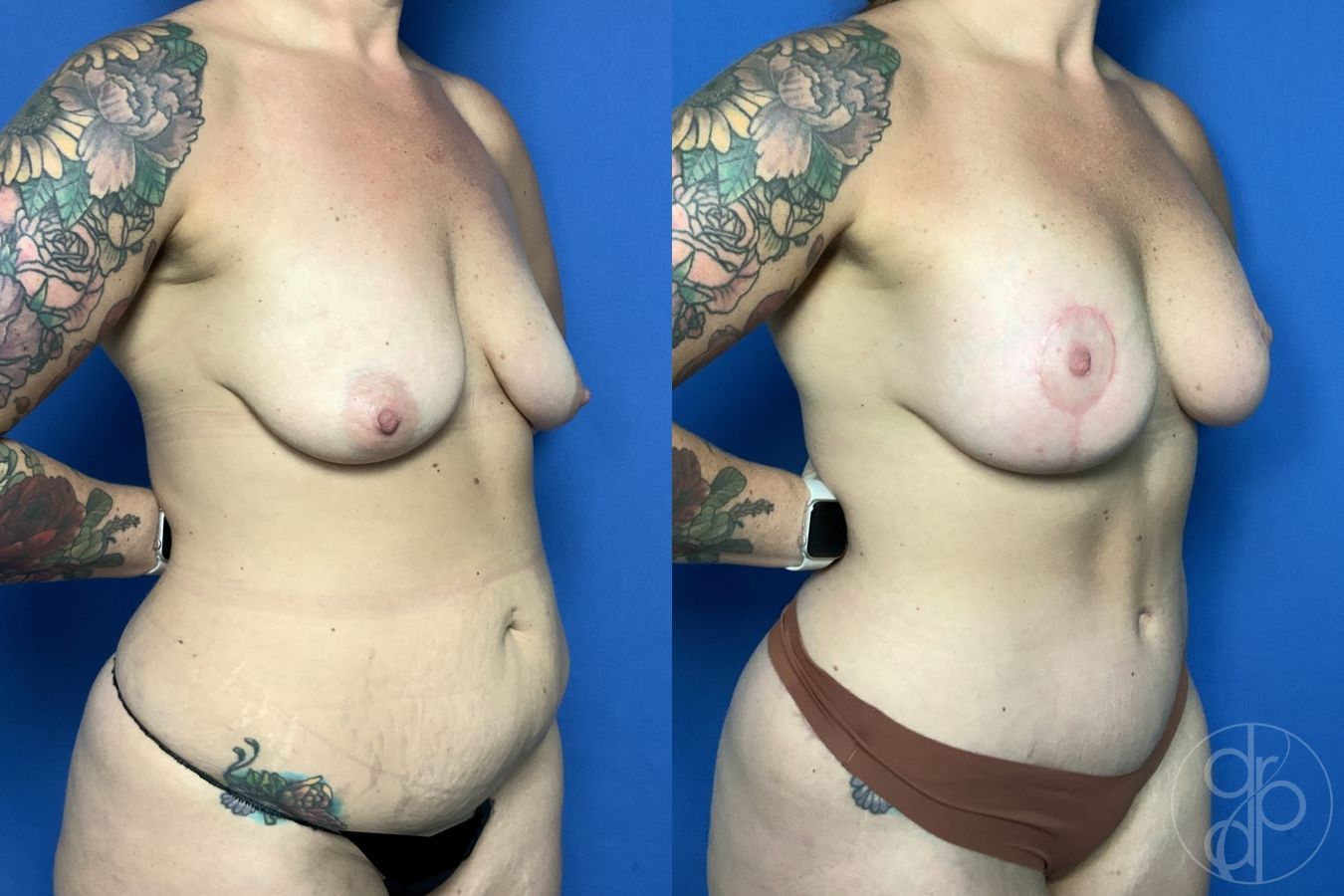 Before and after Breast Augmentation with Lift case 29735 - Angle 3