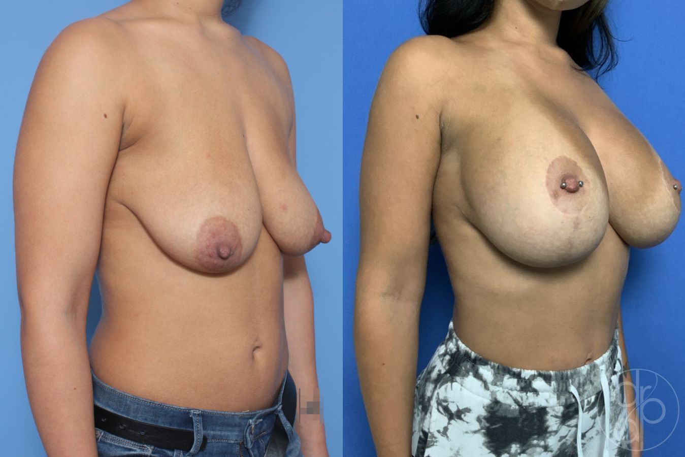 Before and after Breast Augmentation with Lift case 29868 - Angle 3