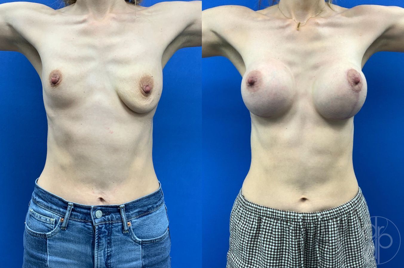Before and after Breast Augmentation case 46255 - Angle 2