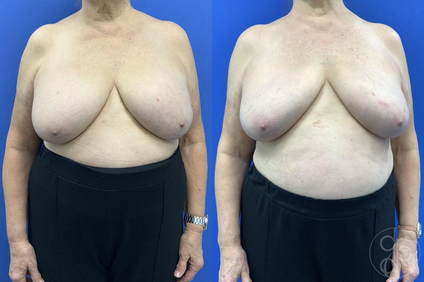 Before and after Breast Implant Removal case 29649