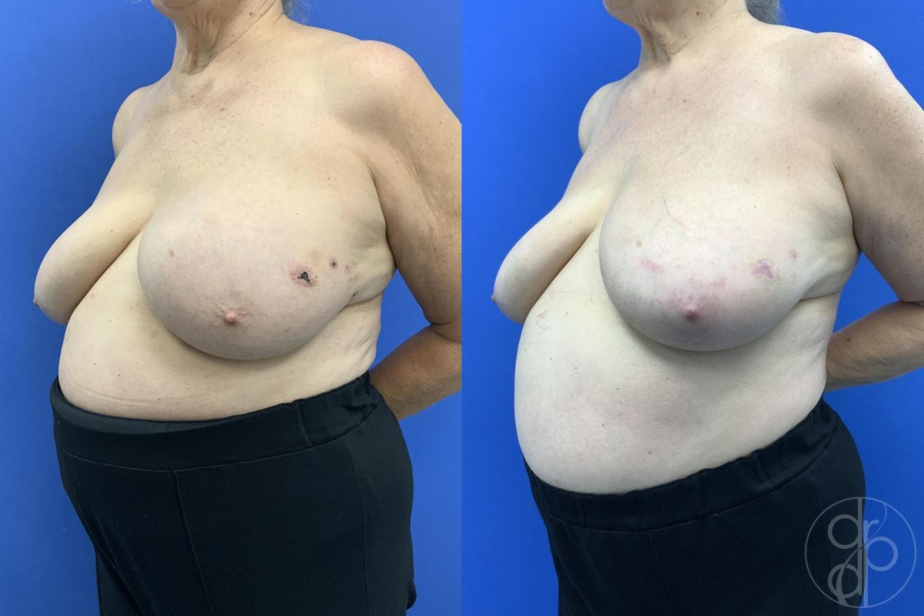 Before and after Breast Implant Removal case 29649 - Angle 3