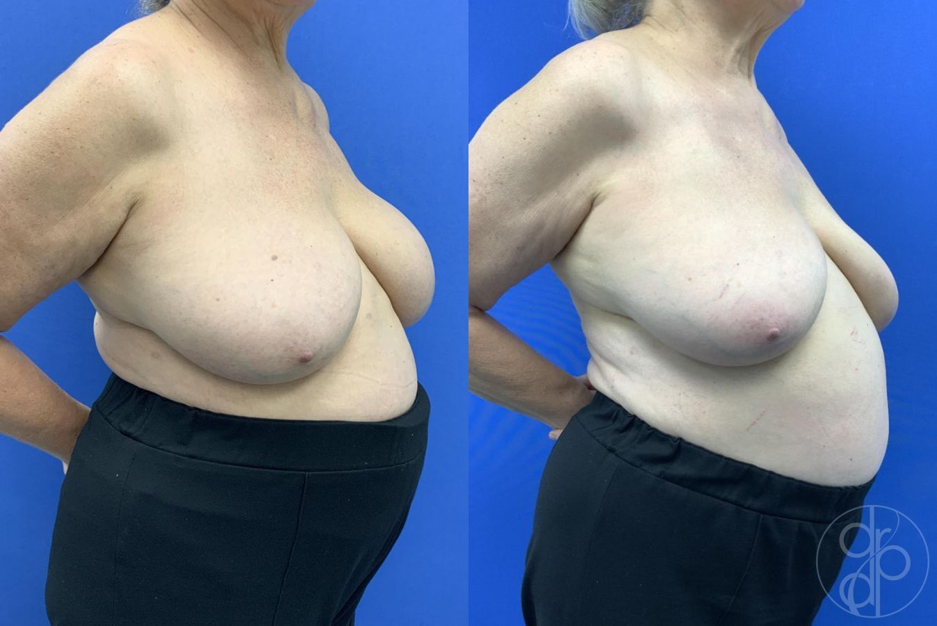 Before and after Breast Implant Removal case 29649 - Angle 4