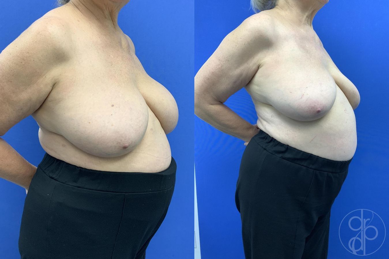 Breast Implant Removal - Thumbnail 4