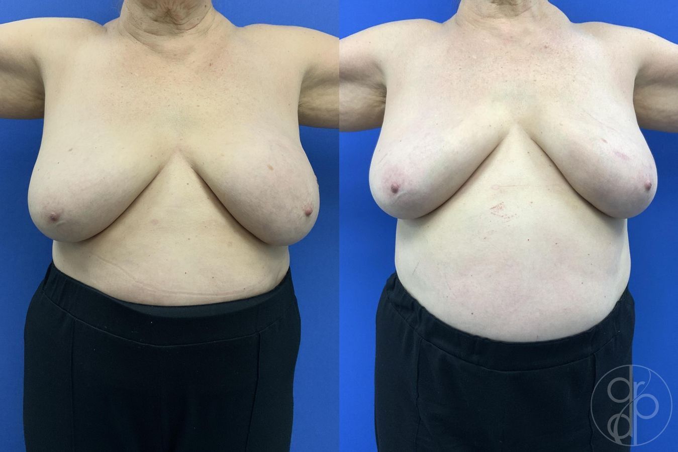 Before and after Breast Implant Removal case 29649 - Angle 2