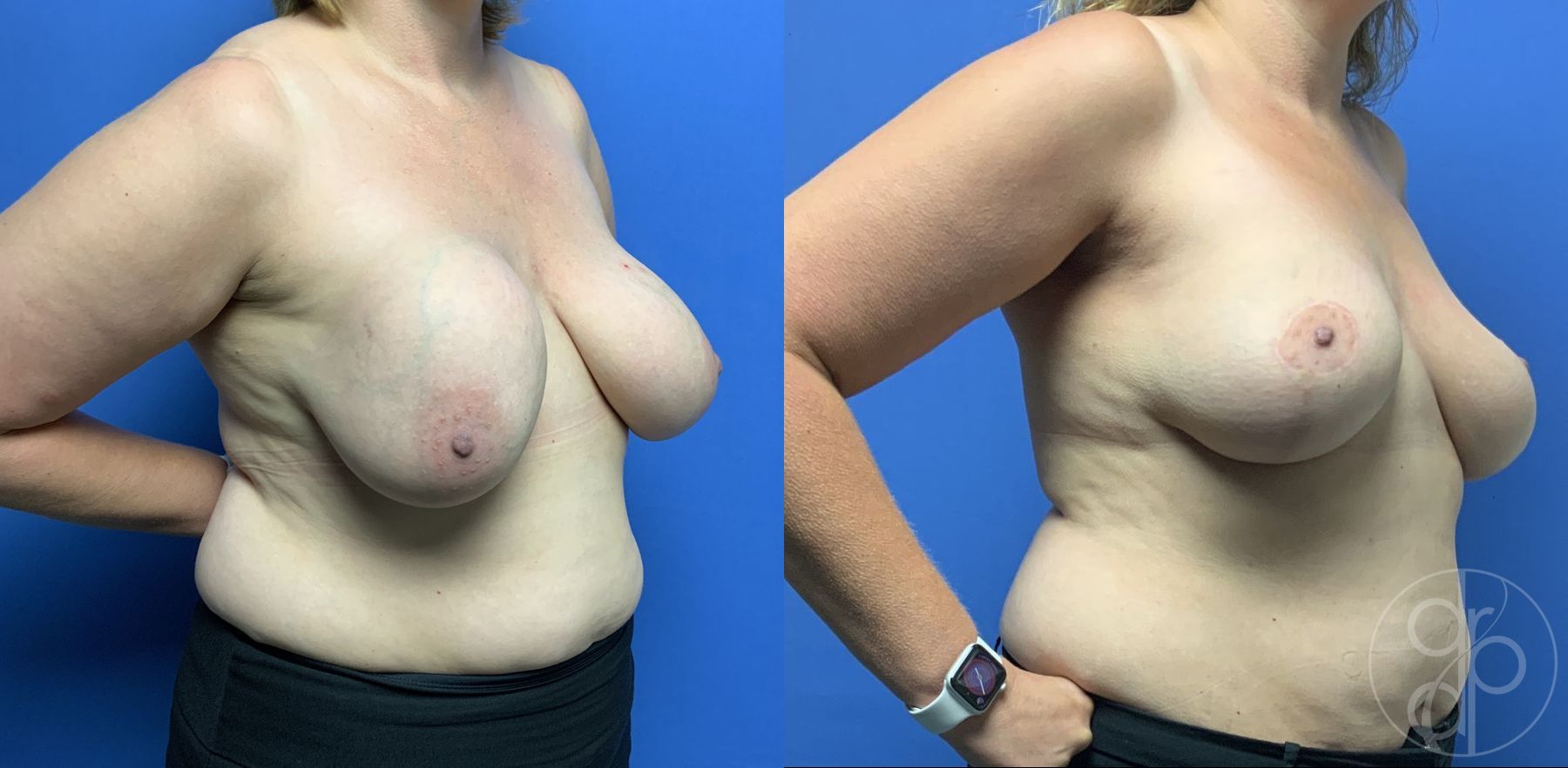 Before and after Breast Implant Removal with Lift case 29809 - Angle 2