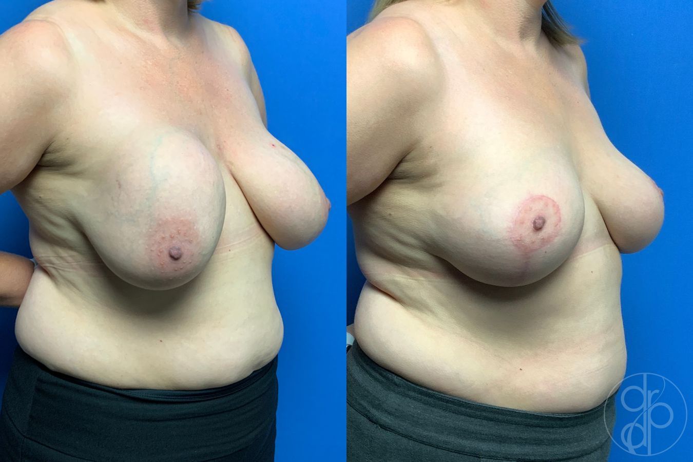 Before and after Breast Implant Removal with Lift case 43281 - Angle 2