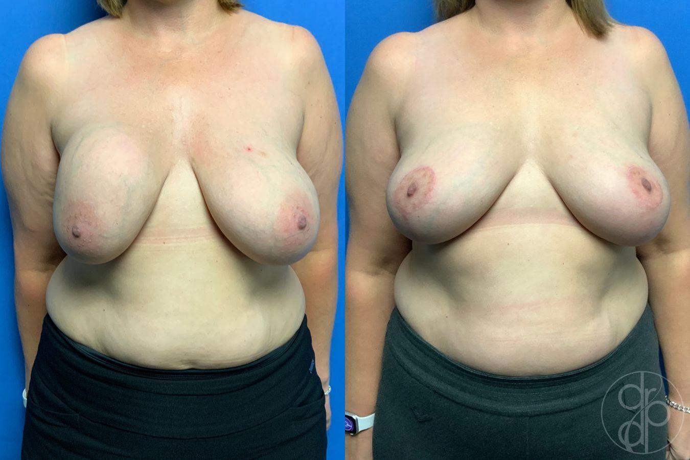 Before and after Breast Implant Removal with Lift case 43281