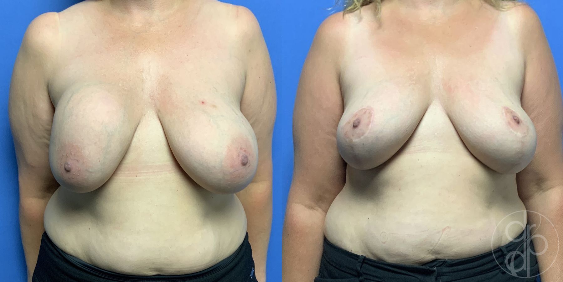 Before and after Breast Implant Removal with Lift case 29809