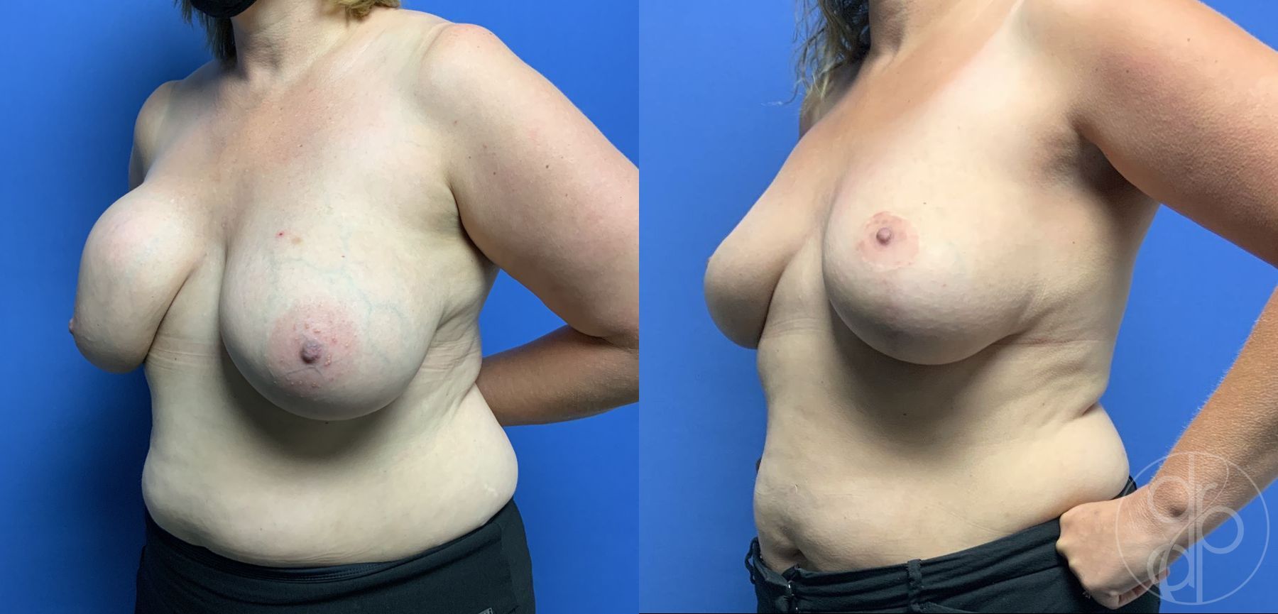 Before and after Breast Implant Removal with Lift case 29809 - Angle 3