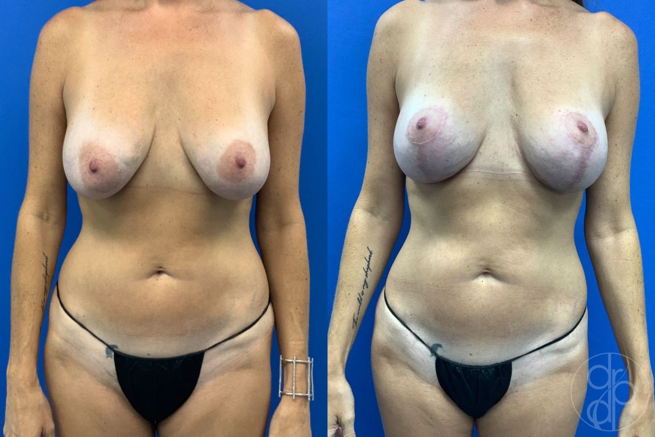 Before and after Liposuction case 43483