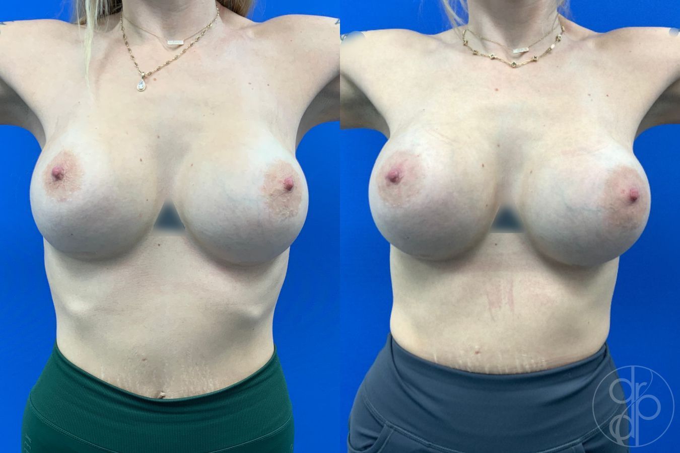Before and after Breast Implant Revision case 43179 - Angle 2