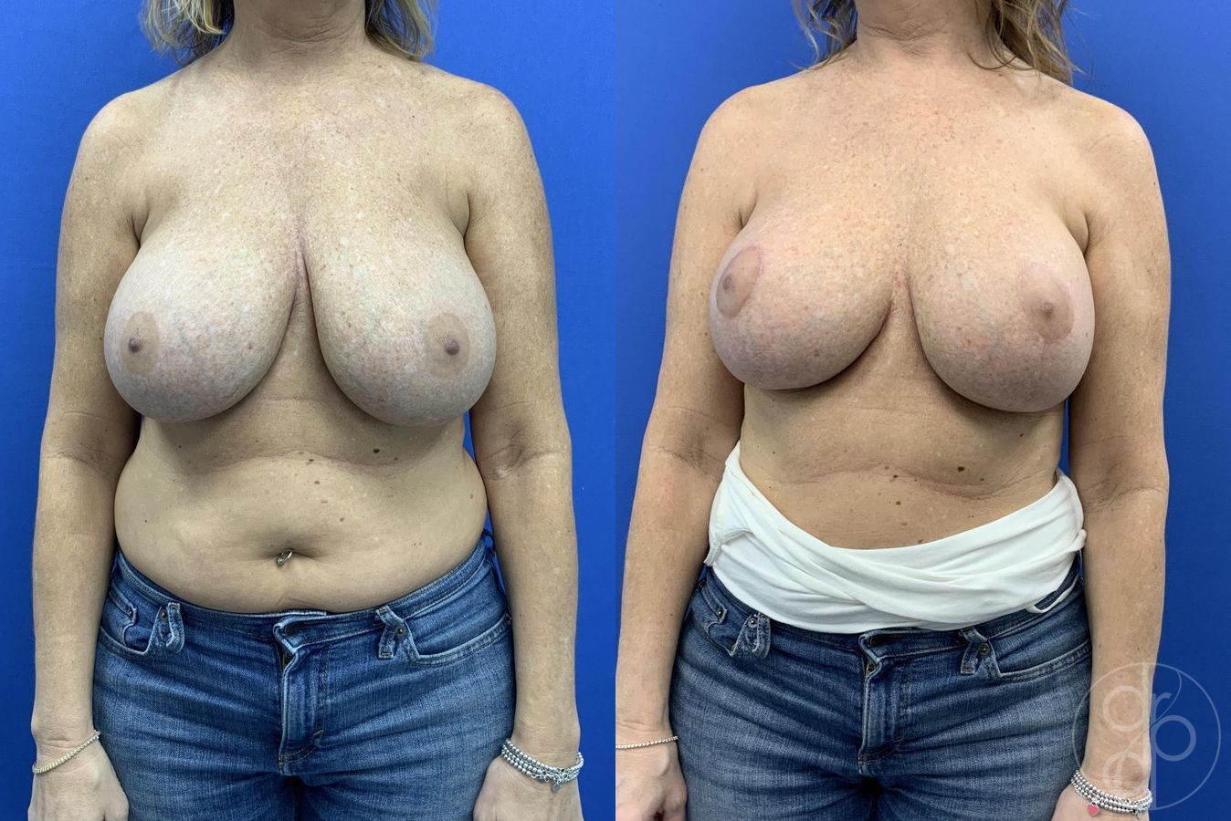 Before and after Breast Implant Revision case 29650