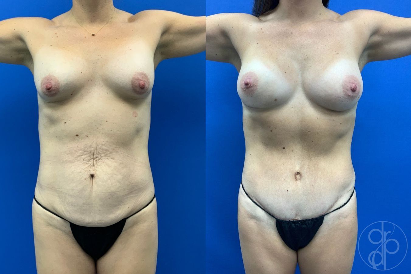 Before and after Abdominoplasty case 46266 - Angle 2