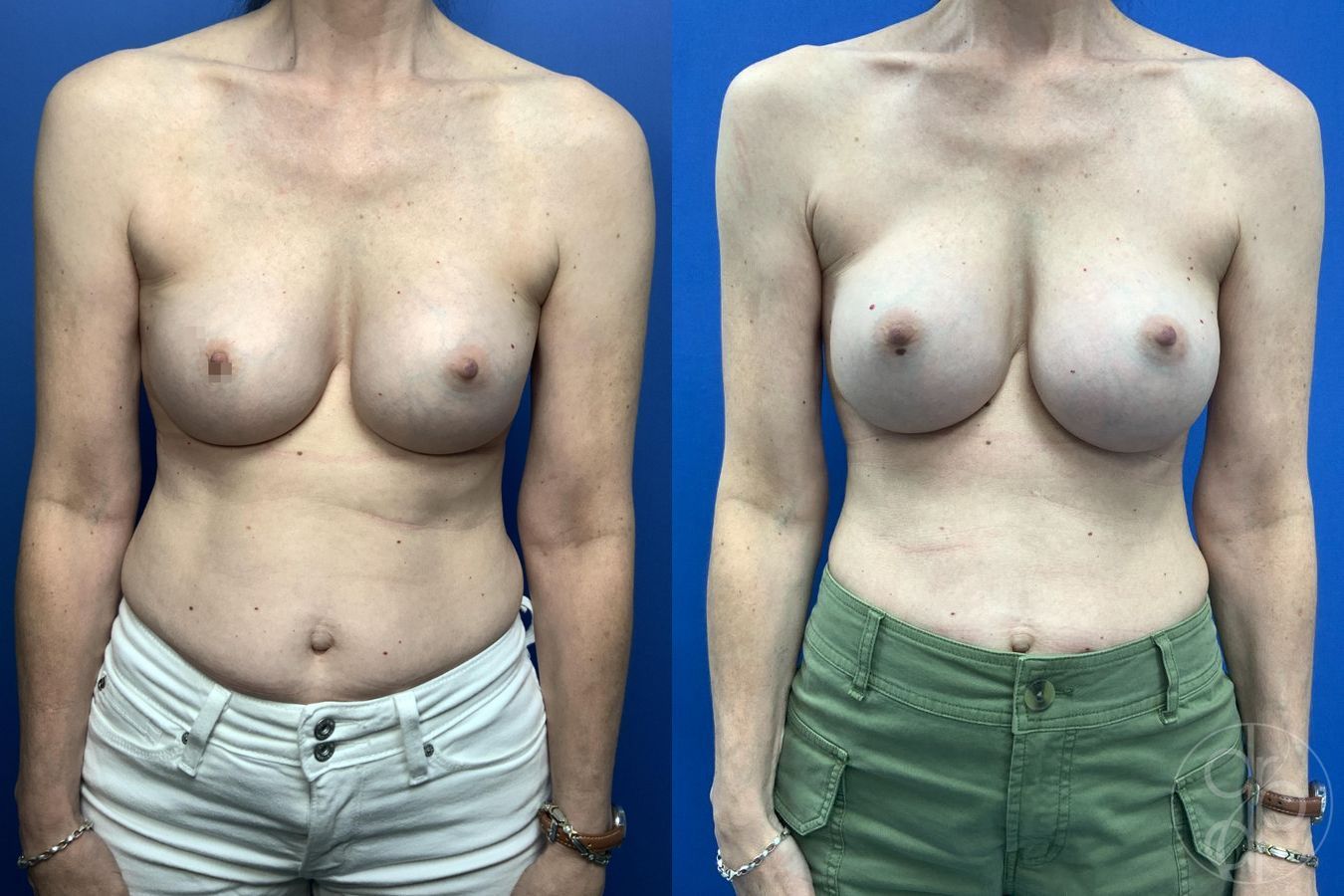 Before and after Breast Implant Revision case 30001