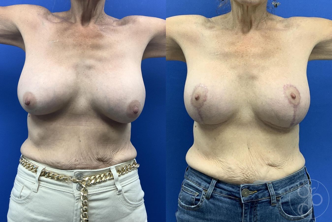 Before and after Breast Implant Revision case 30010 - Angle 2