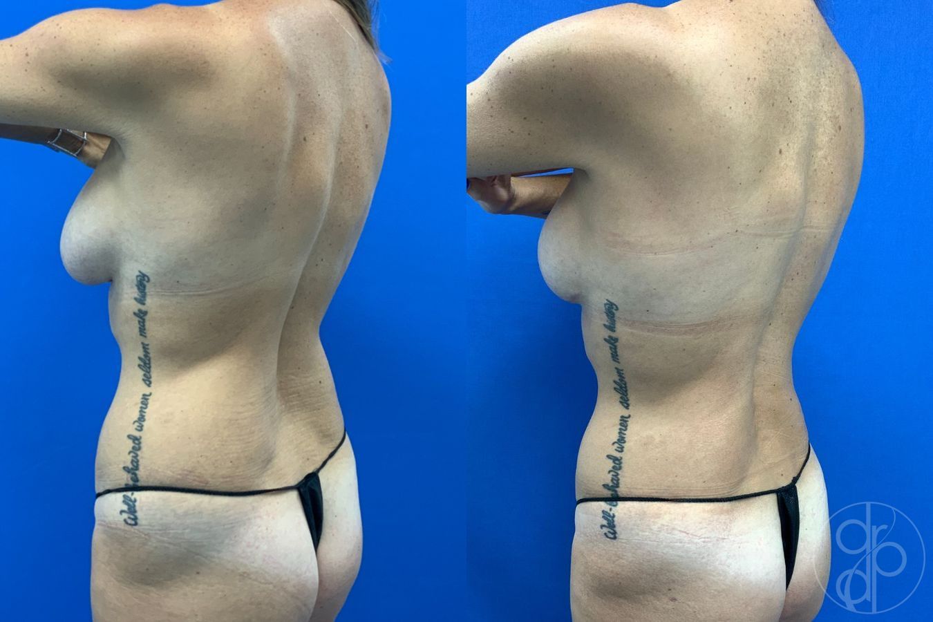 Before and after Liposuction case 43483 - Angle 4