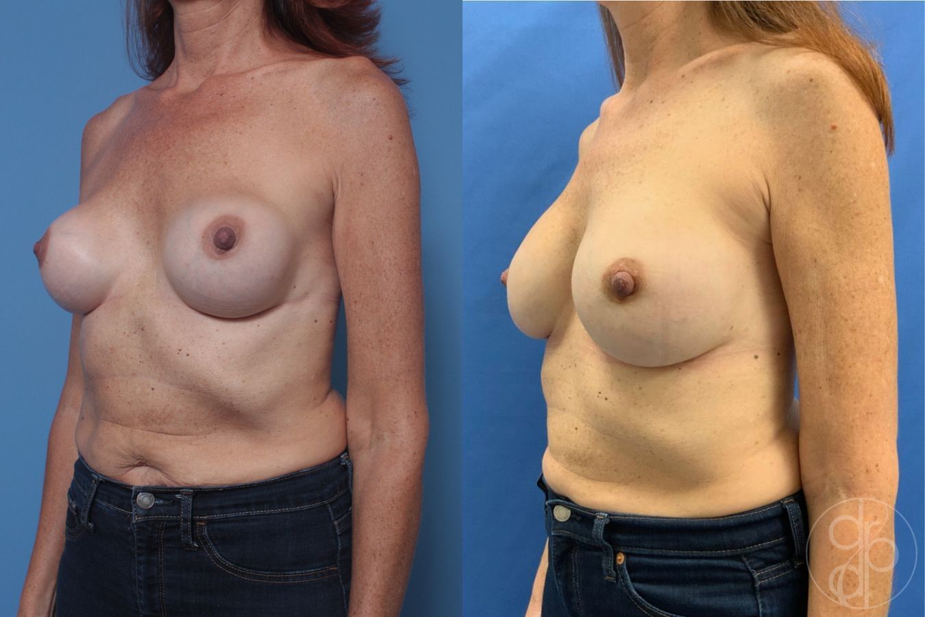 Before and after Breast Implant Revision case 29846 - Angle 3