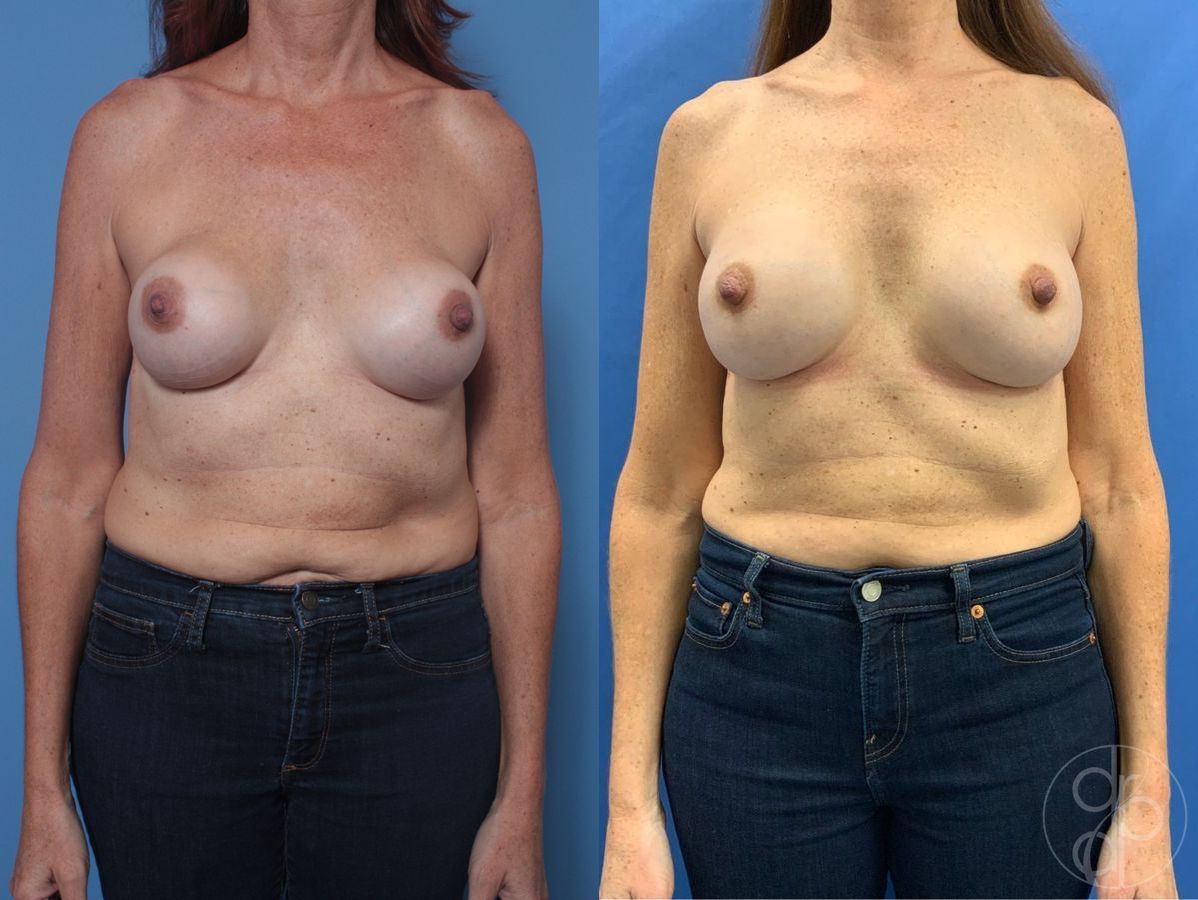 Before and after Breast Implant Revision case 29846