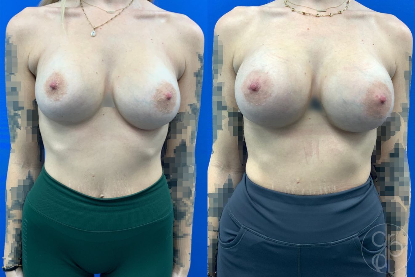 Before and after Breast Implant Revision case 43179