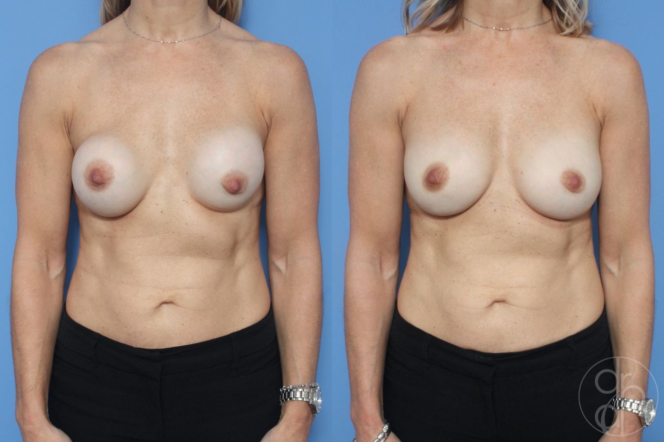Before and after Breast Implant Revision case 29873