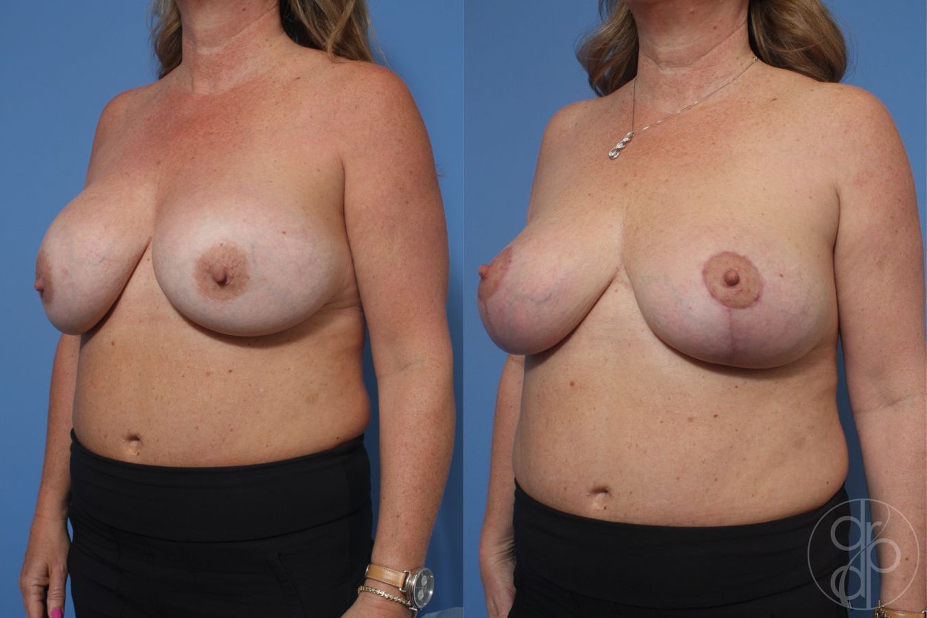 Before and after Breast Augmentation with Lift case 29757 - Angle 3