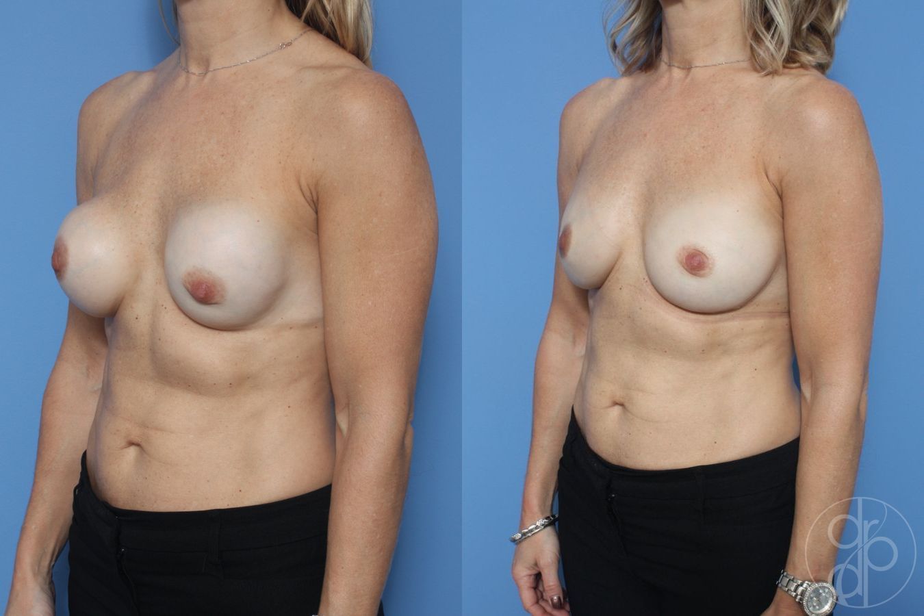 Before and after Breast Implant Revision case 29873 - Angle 3