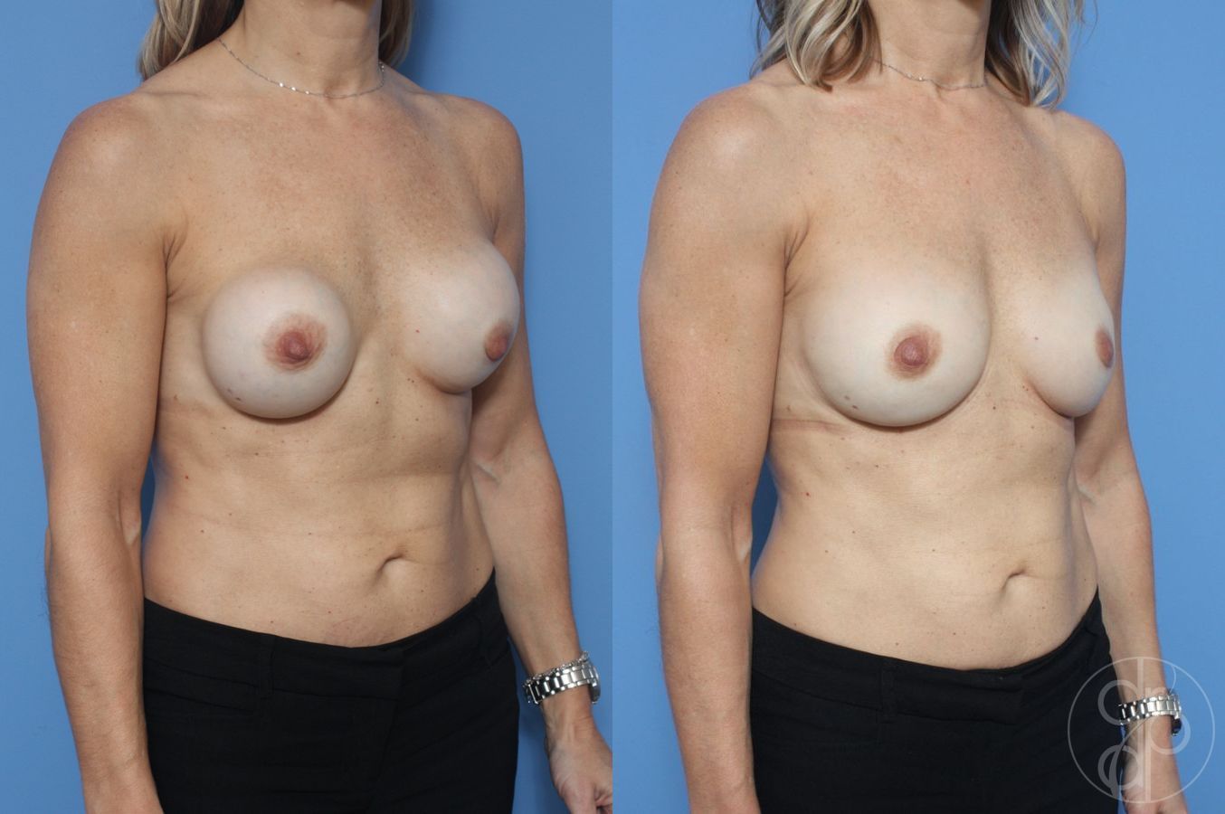 Before and after Breast Implant Revision case 29873 - Angle 2