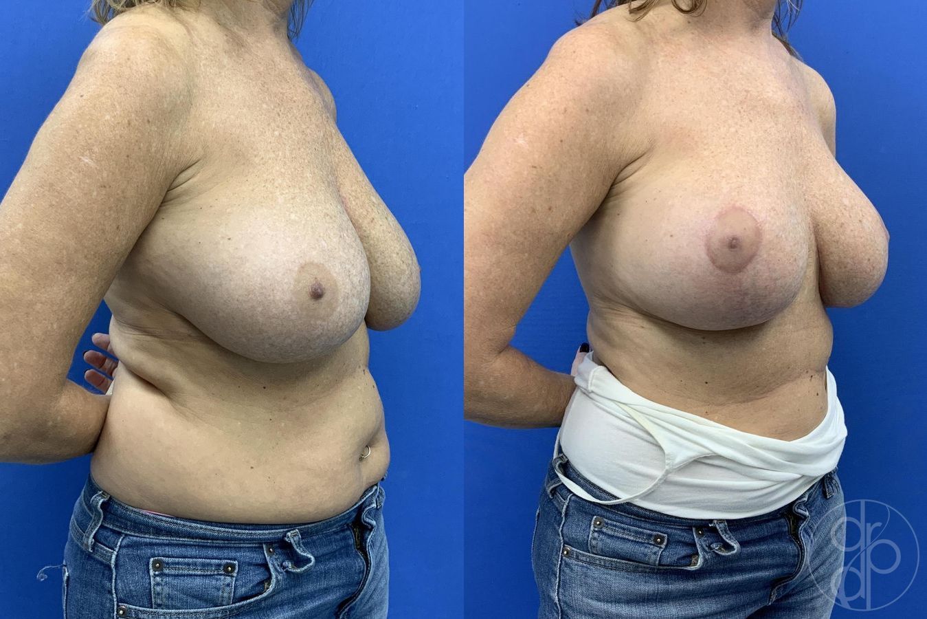 Before and after Breast Implant Revision case 29650 - Angle 4