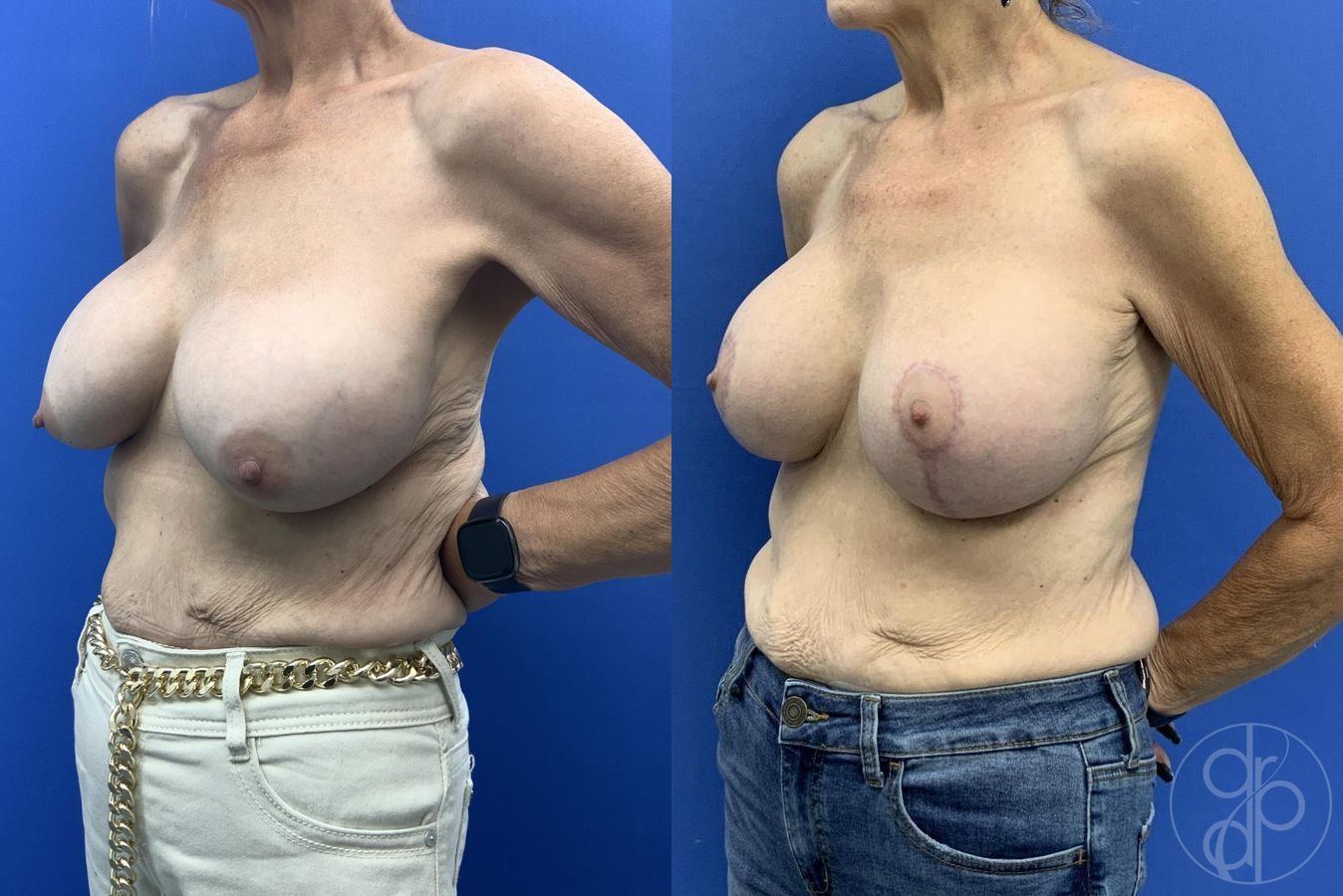 Before and after Breast Implant Revision case 30010 - Angle 4