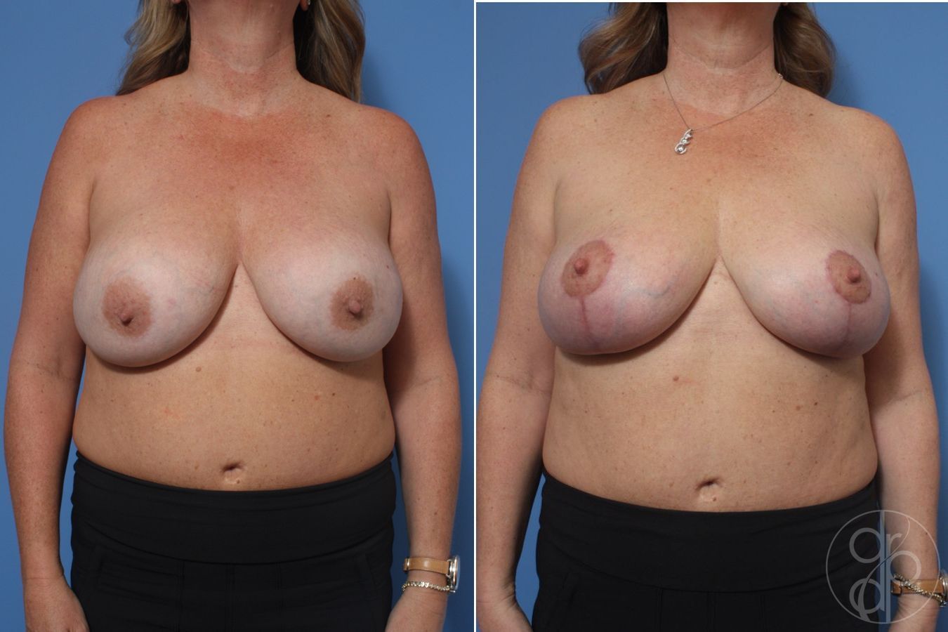 Before and after Breast Augmentation with Lift case 29757
