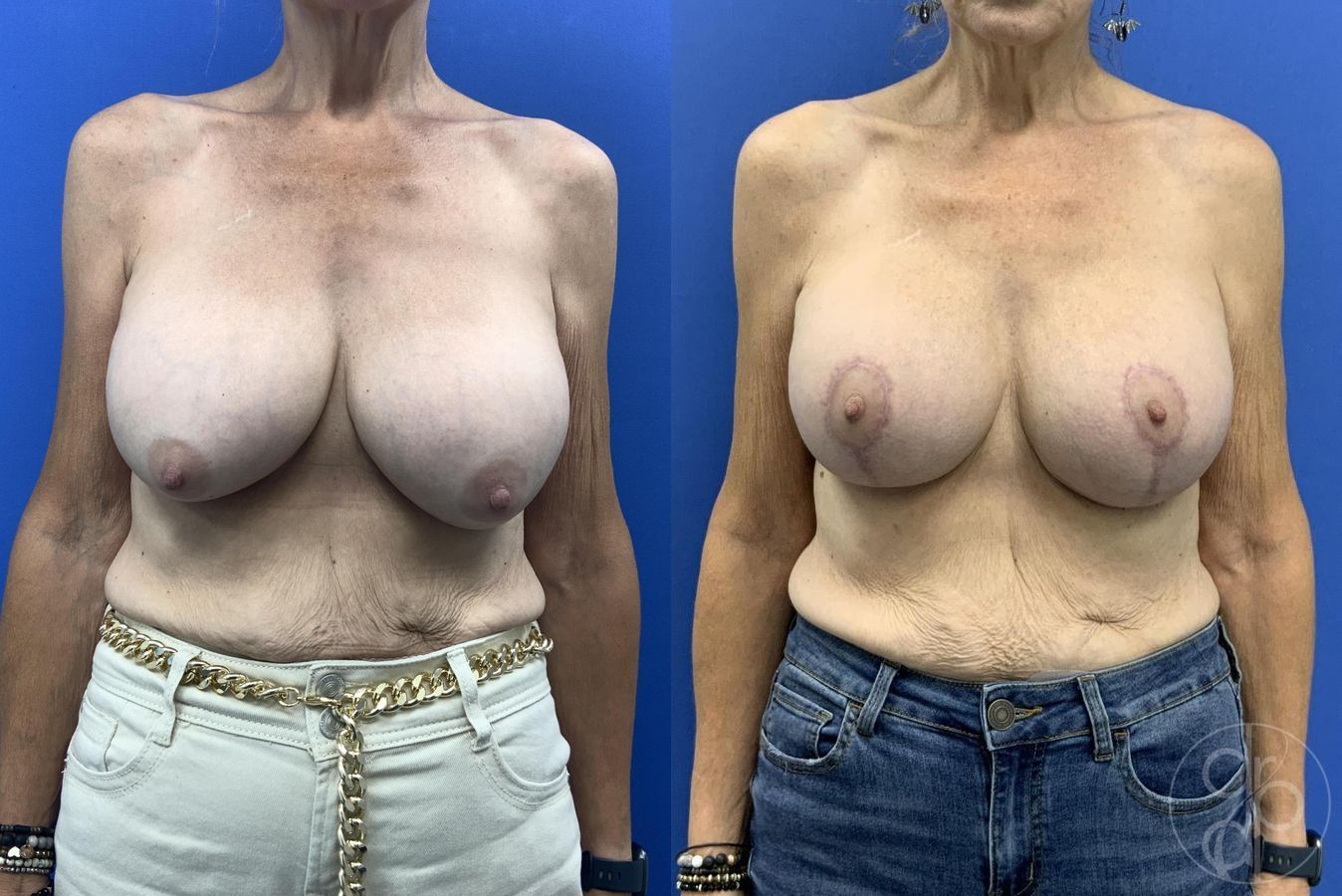 Before and after Breast Implant Revision case 30010