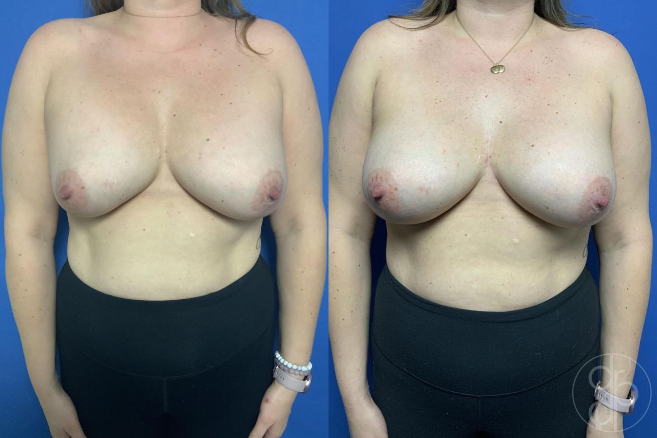 Before and after Breast Implant Revision case 29608